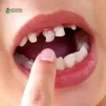 Problemas dentales comunes en los niños y cómo prevenirlos: una guía para padres de Los Ángeles